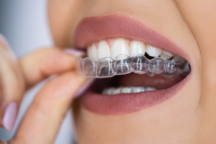 Ortodoncia y periodontitis: ¿qué consejos debes seguir si antes de la ortodoncia has sufrido una enfermedad periodontal?