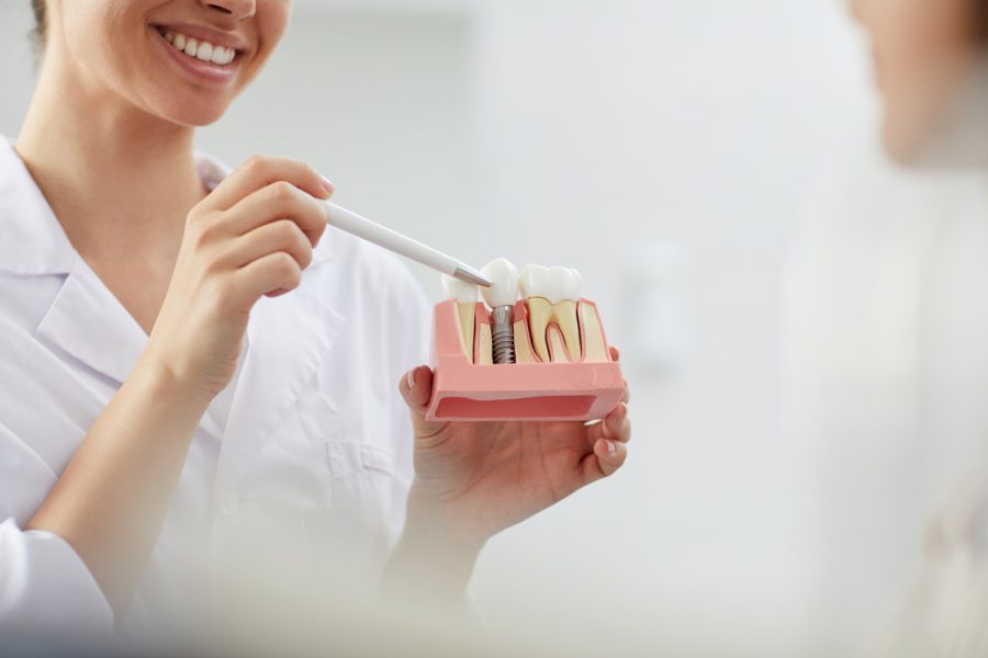 ¿Cuánto dura un implante dental?